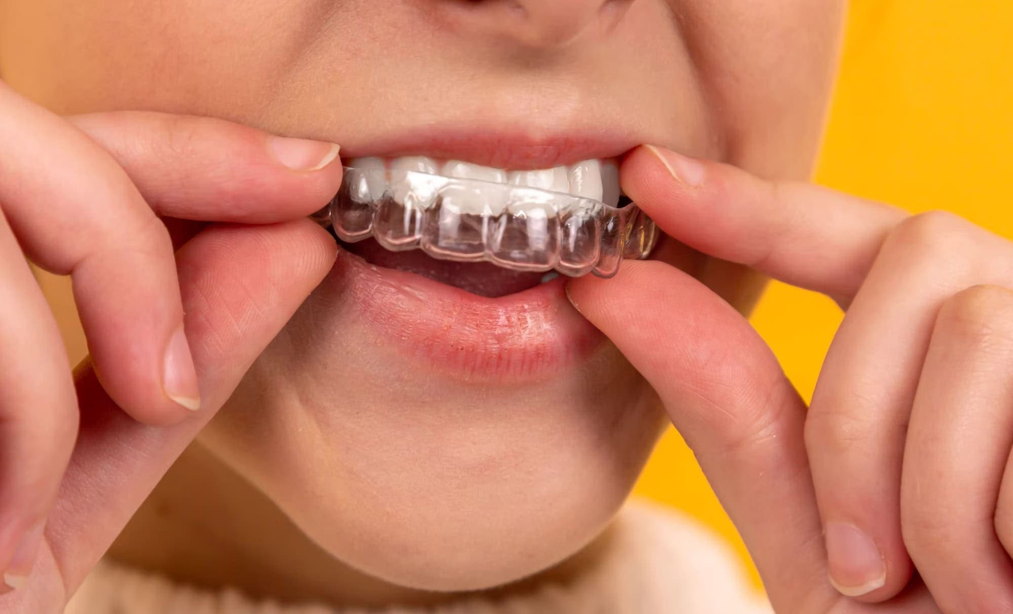 Najbolji komplet za izbjeljivanje zubi